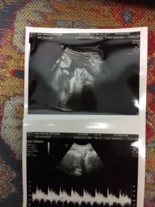 baby Rose, 35 weeks ultrasound